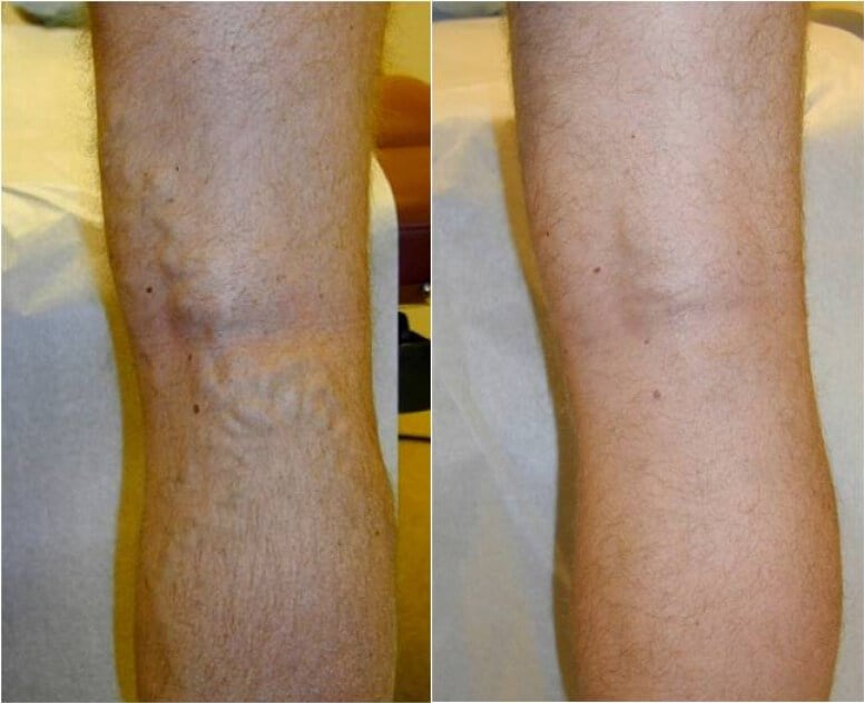 Varicose Veins Treatment Before And After Pictures